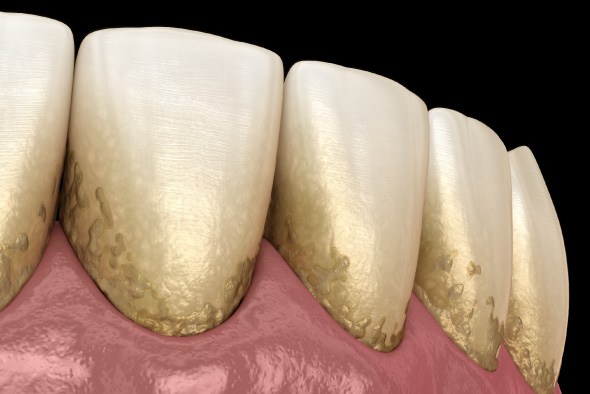 むし歯を引き起こす主な原因とは