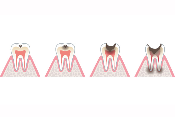 むし歯の進行と治療方法