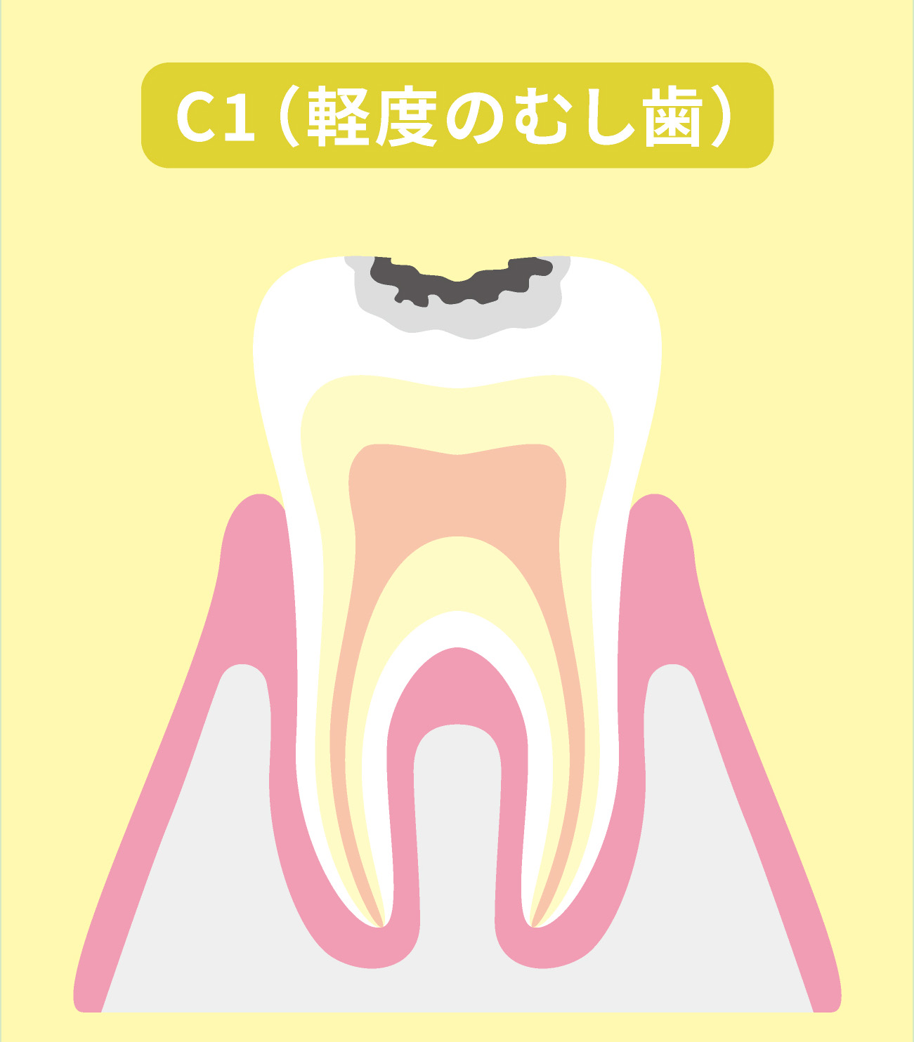 初期段階のむし歯（C1）