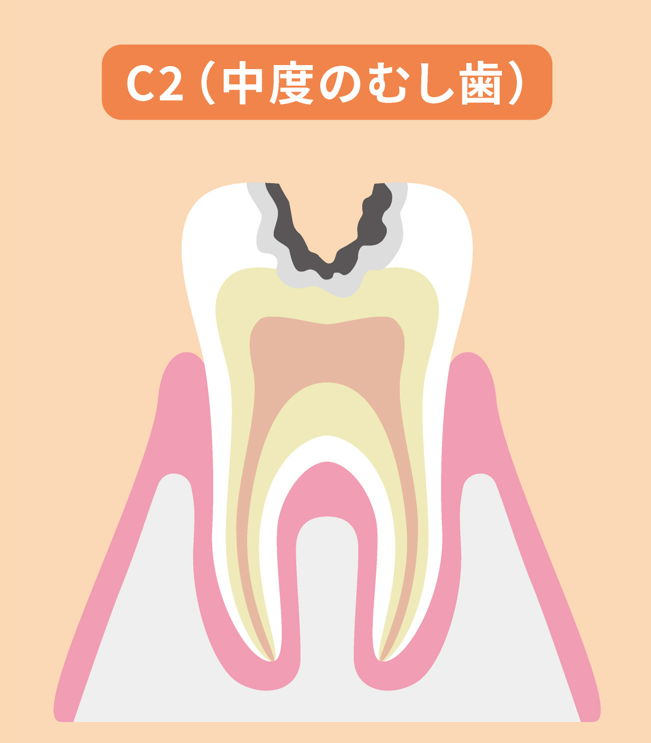 象牙質に進行したむし歯（C2）