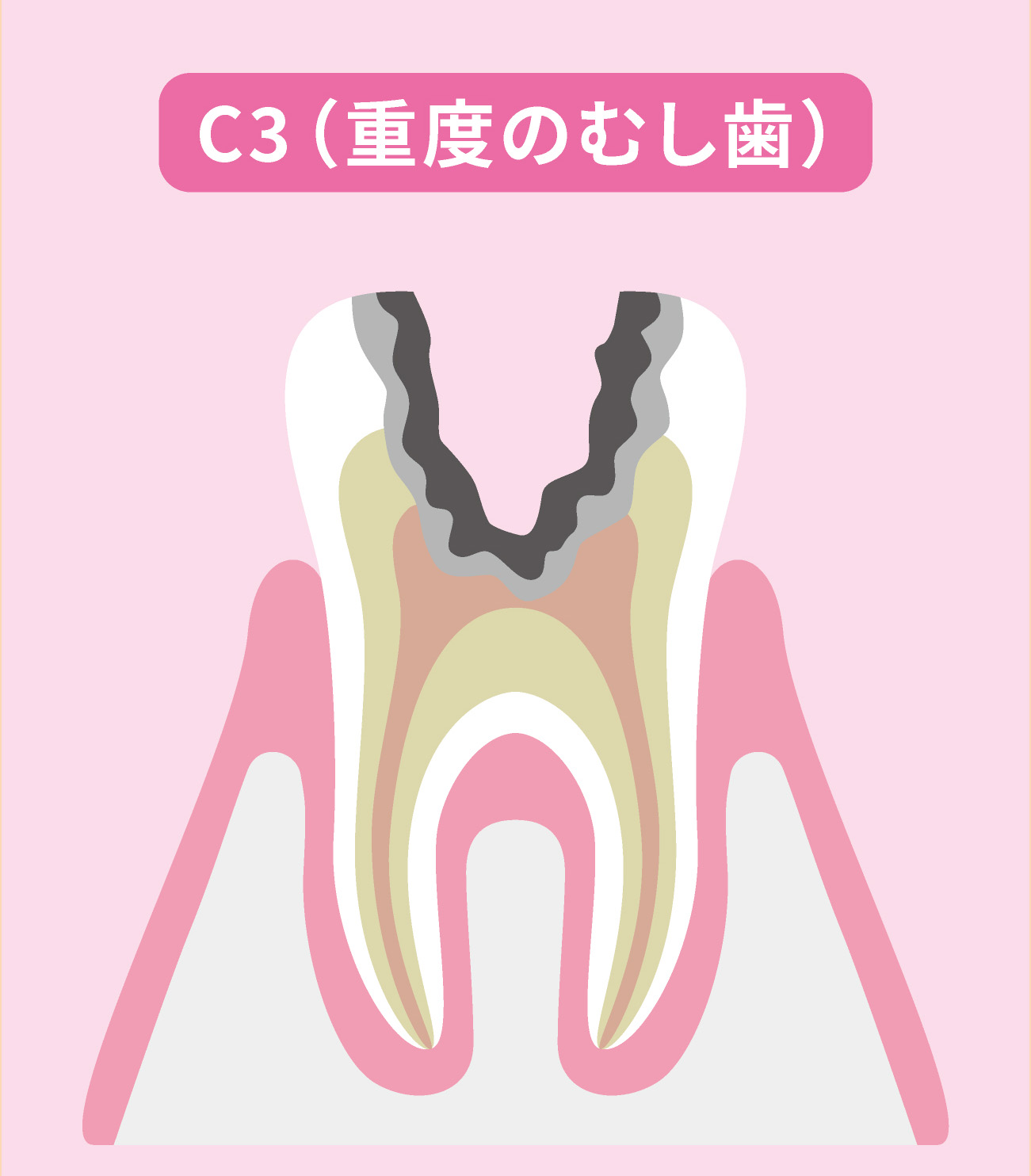 神経に達したむし歯（C3）