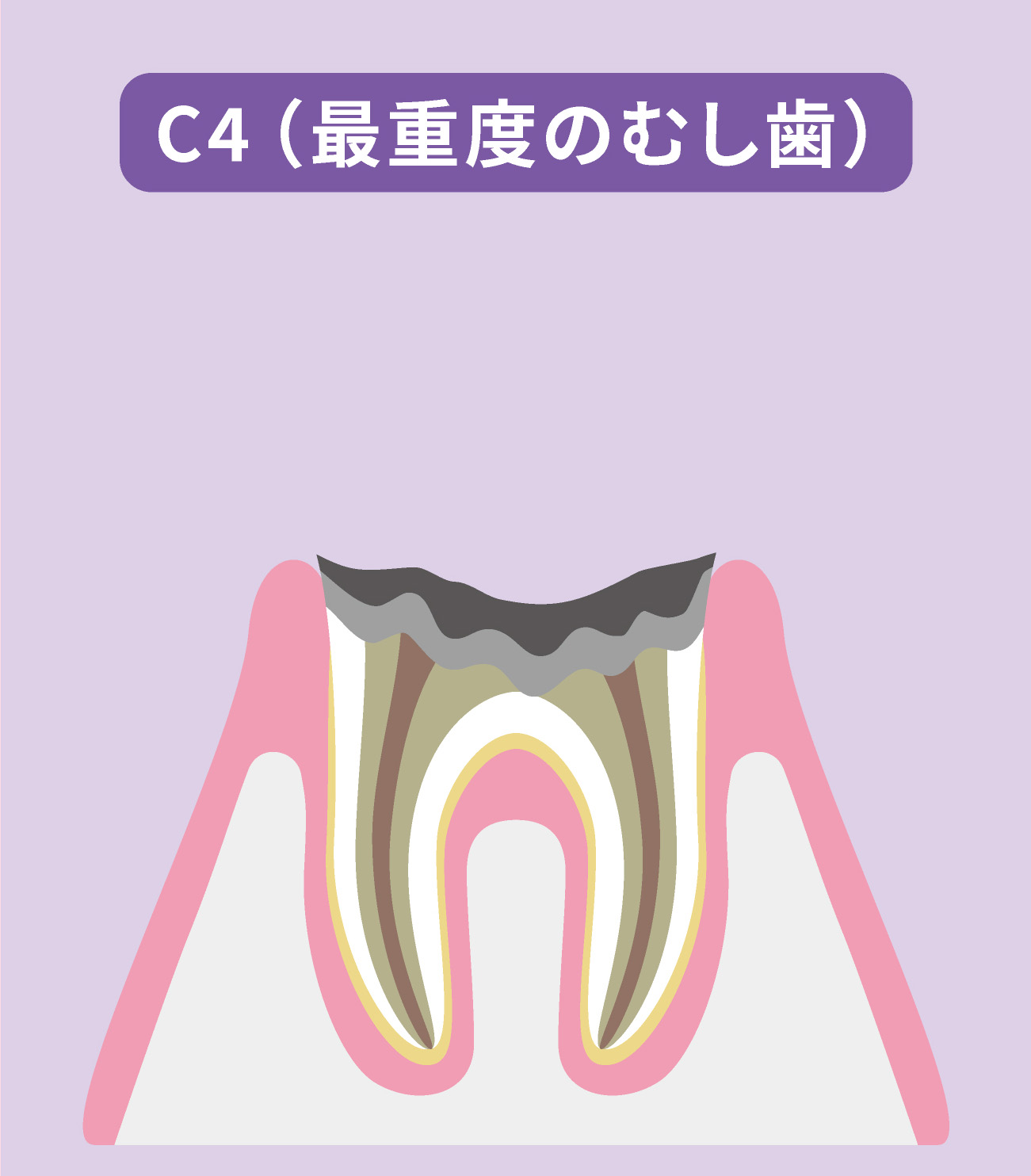 歯を失うリスクがあるむし歯（C4）